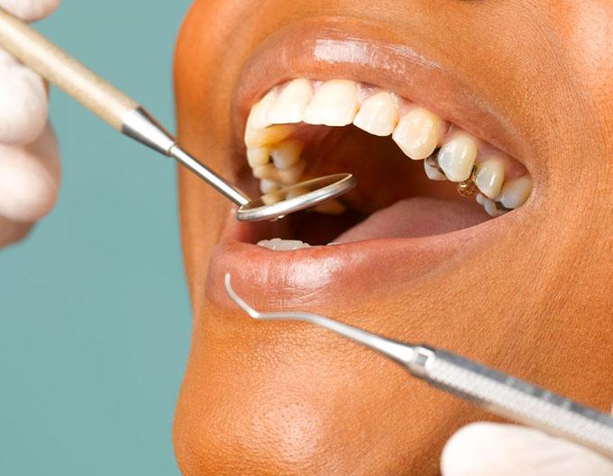 Bhandari Dental Care dental cleaning