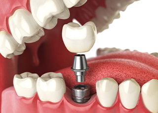 Dental Implants - Bhandari Dental Care